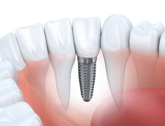 Image showing the titanium implant that screws securely into the jaw bone.
