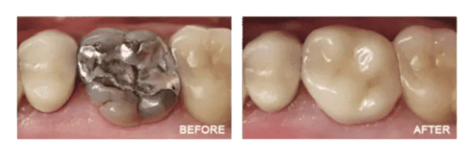 Before and after images of a tooth rebuilt using CEREC crowns.