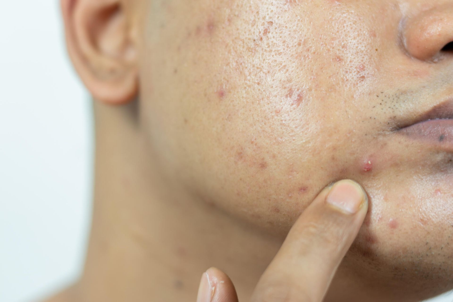 A close up of a man 's face with acne.
