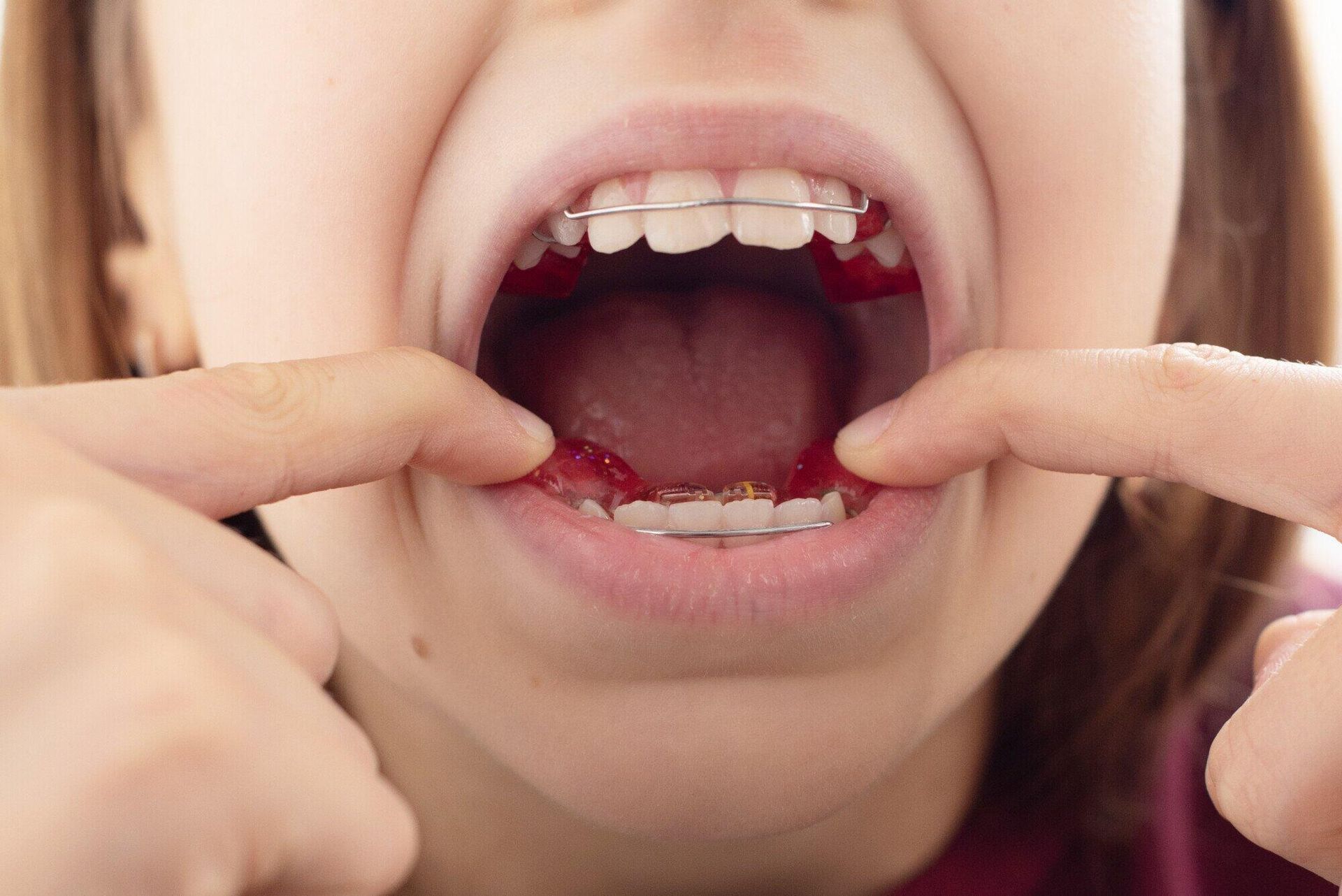 A close up of a child 's mouth with braces on it.