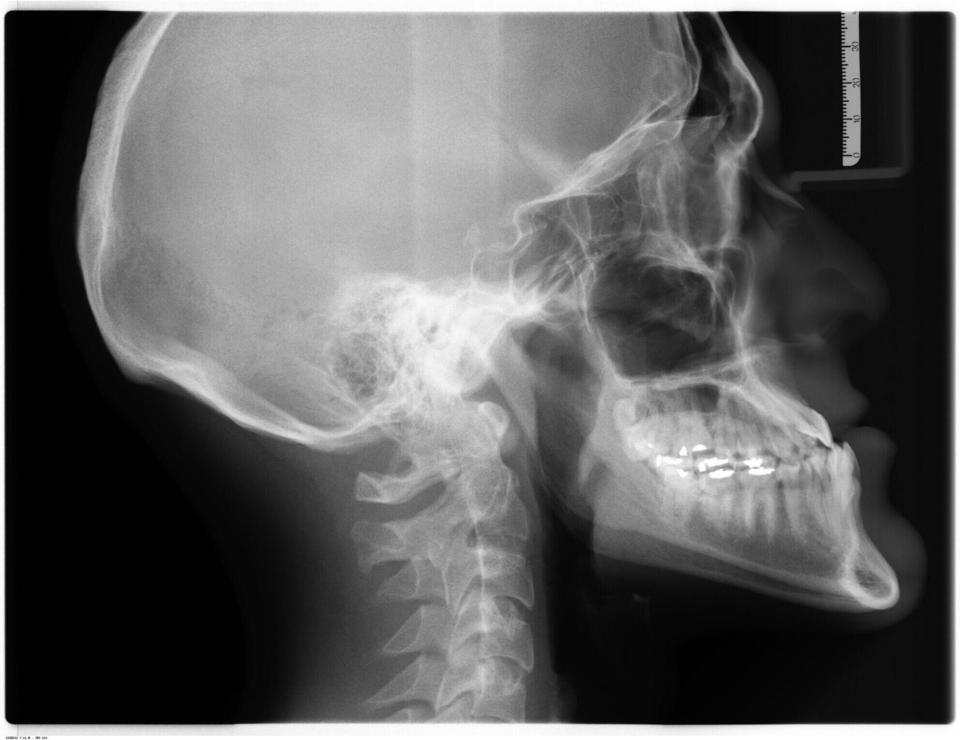 A black and white x-ray of a human skull and neck.