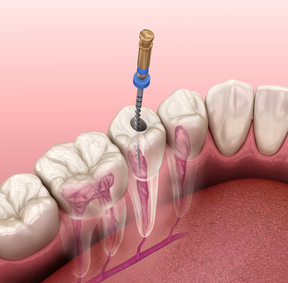 Illustration of a Tooth Undergoing a Root Canal Procedure — JCU Dental In Smithfield, QLD