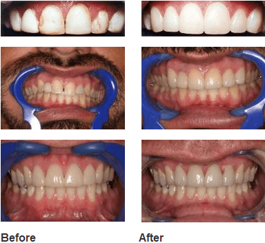 Before & after images of teeth