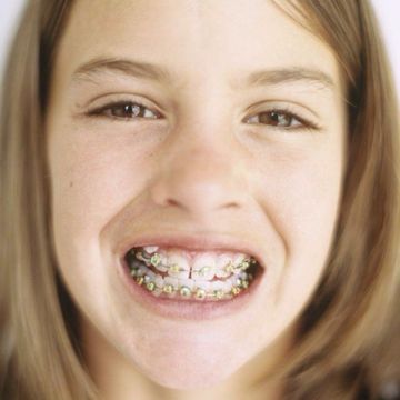 A girl with braces after teeth cleaning in Kailua, HI