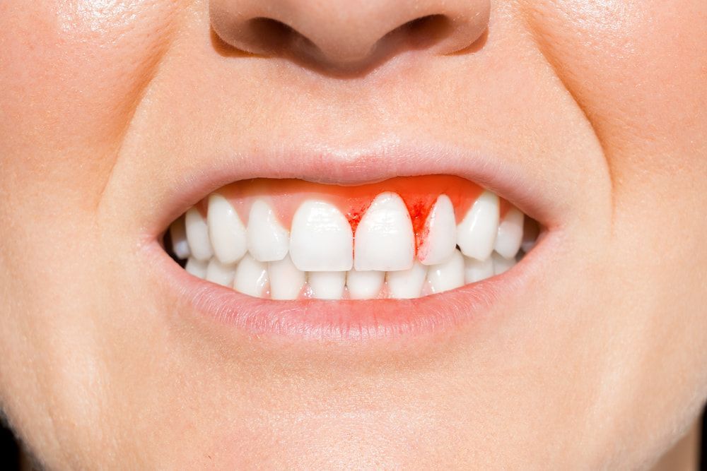 Woman With Bleeding Gums — Dental Services in Gracemere, QLD