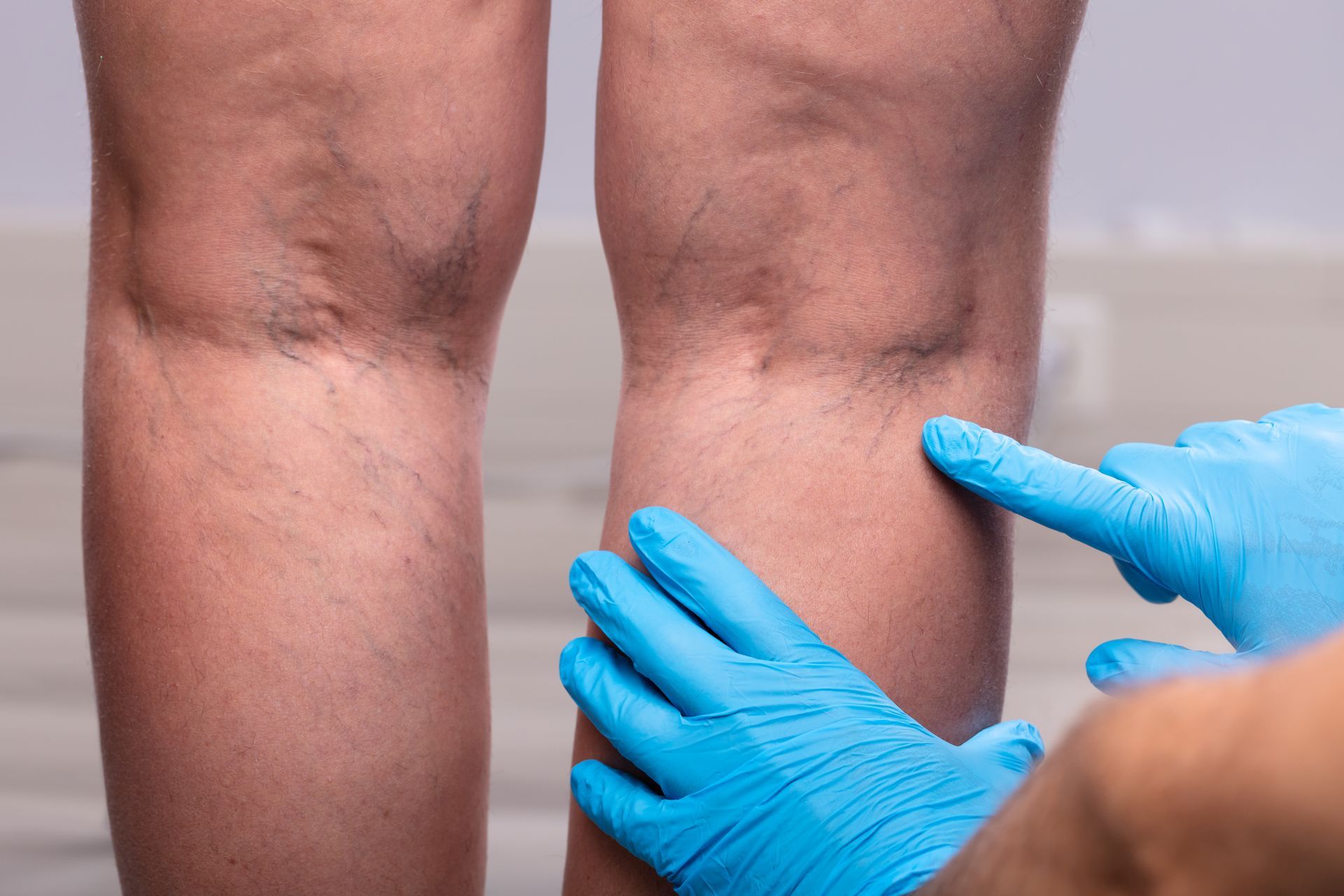 A doctor is examining a woman 's leg with varicose veins.