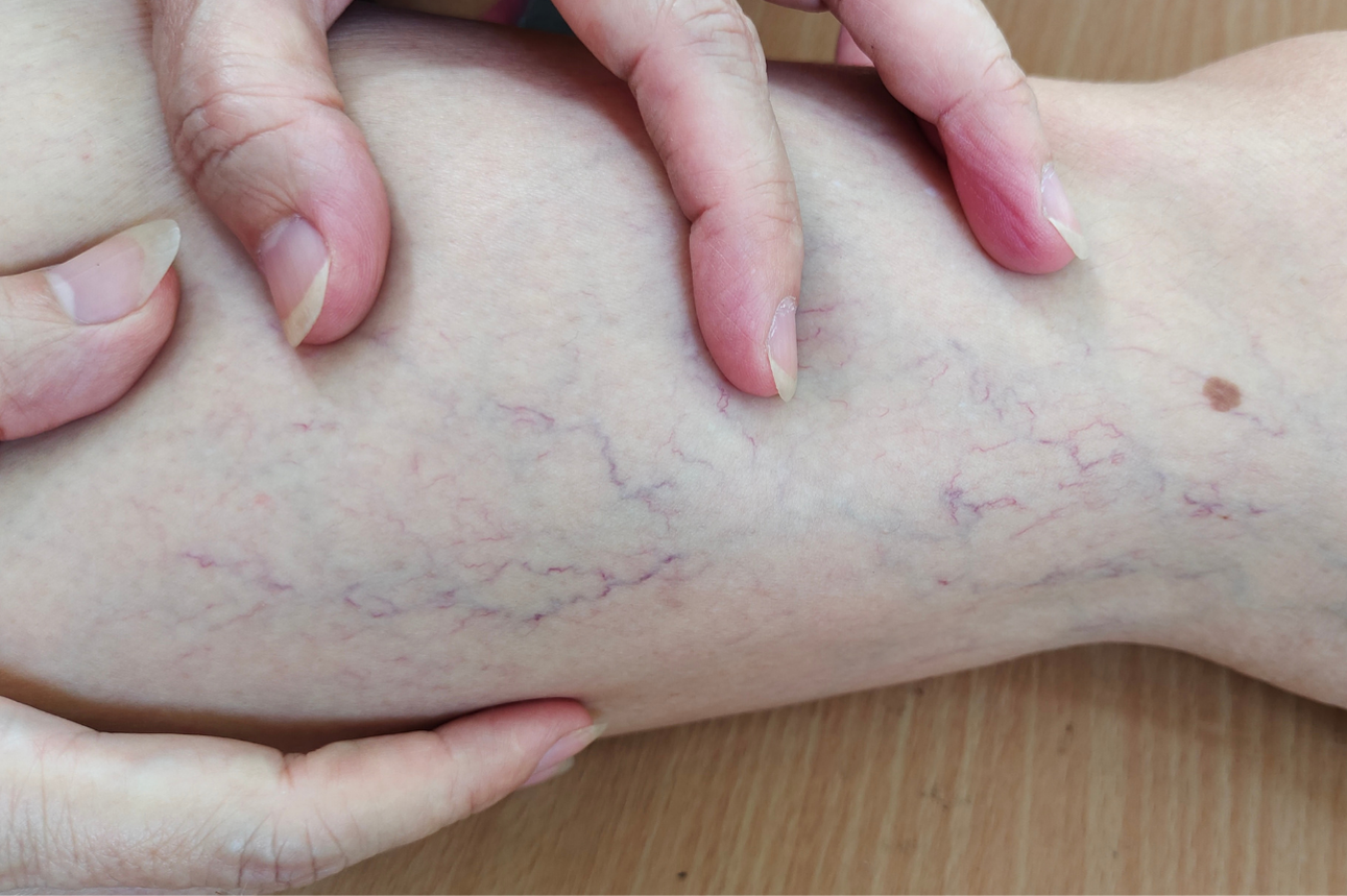 Leg with visible spider veins, touched by two hands.