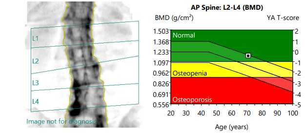 Bone Mineral Density