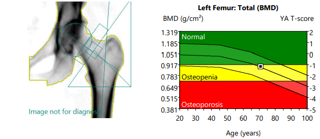 Bone Mineral Density