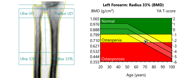 Bone Mineral Density