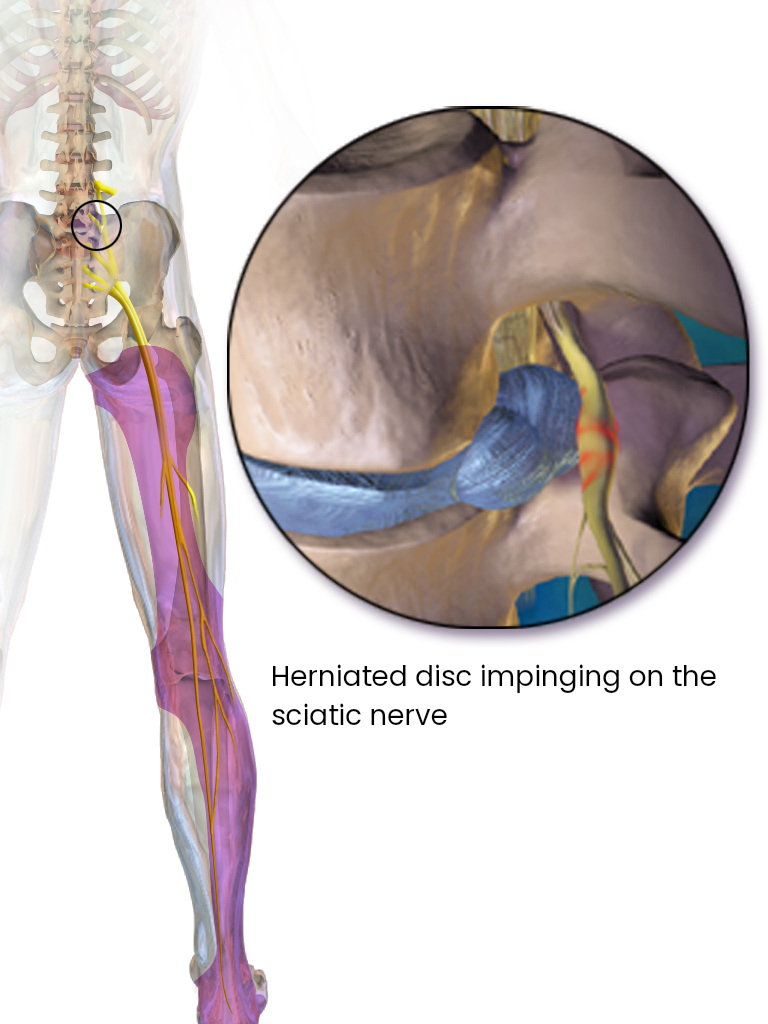 Herniated disc causing sciatica