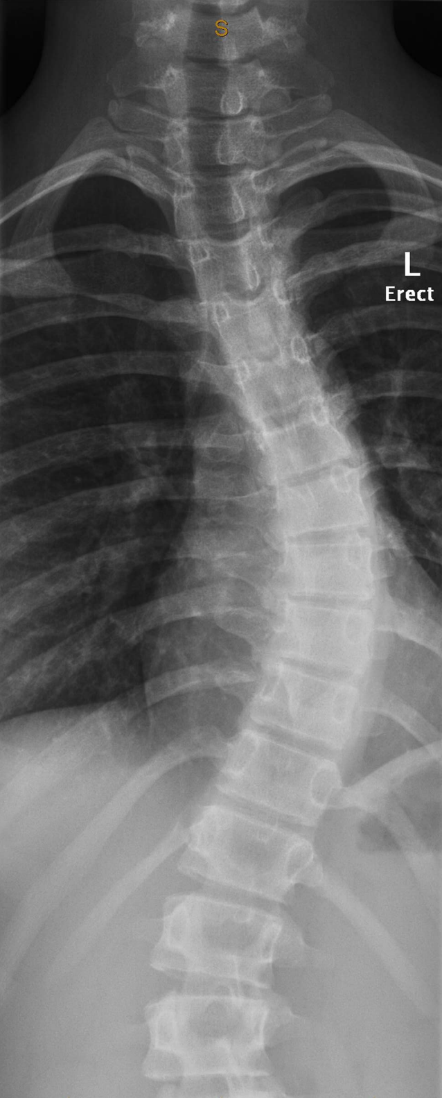 Scoliosis and Chiropractic