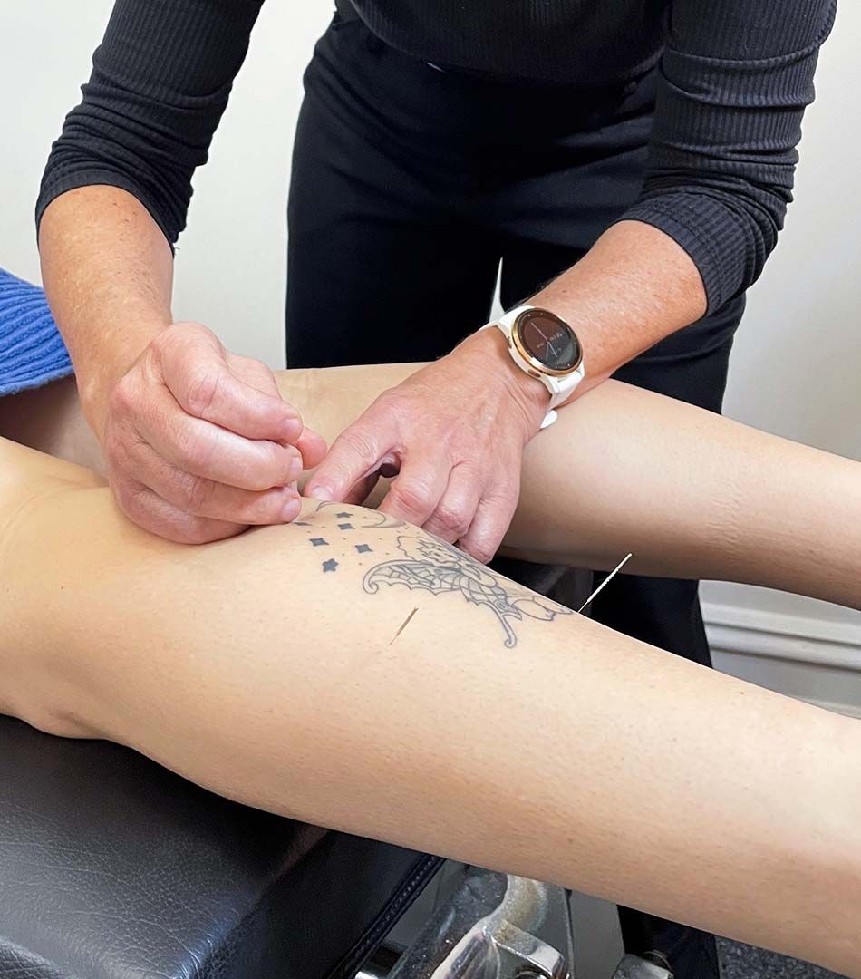 Dry Needling and Chiropractic