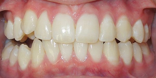 Invisalign Treatment