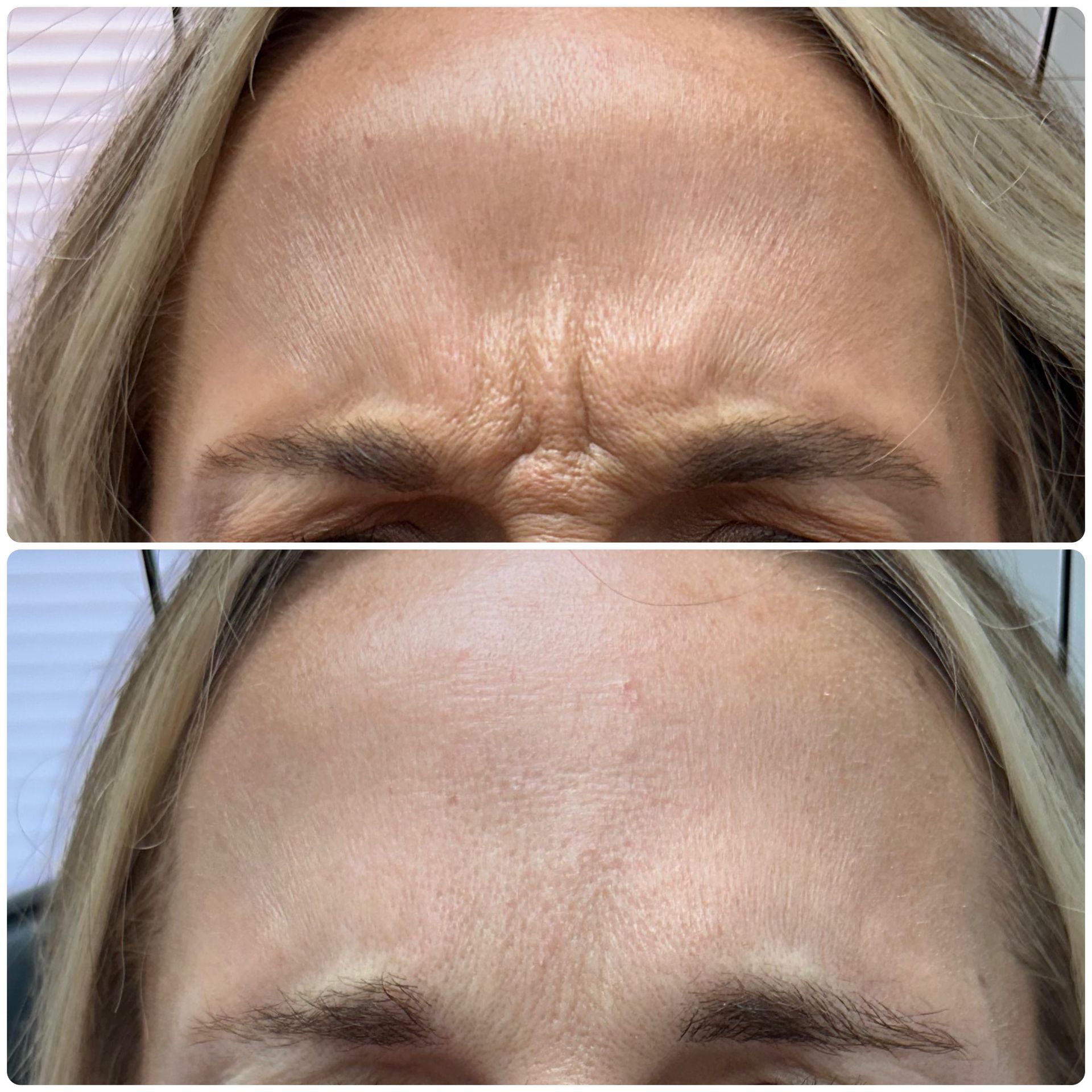 A before and after photo of a woman 's forehead with wrinkles.