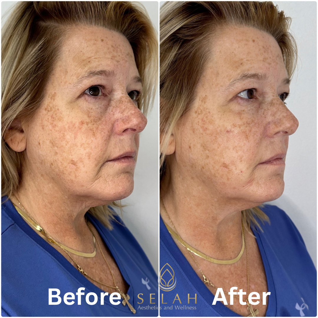 A before and after photo of a woman 's face