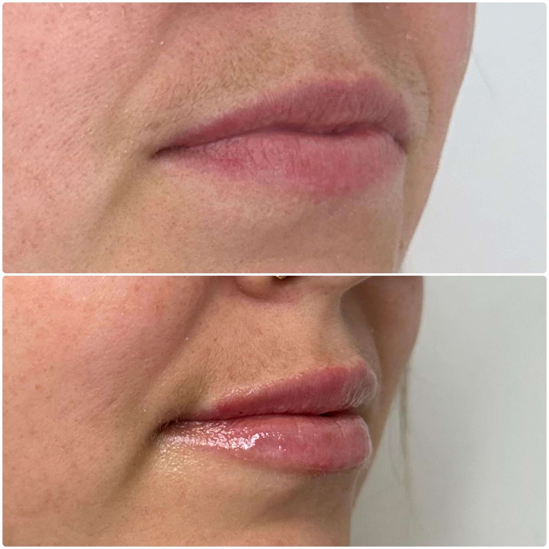 A before and after photo of a woman 's lips.