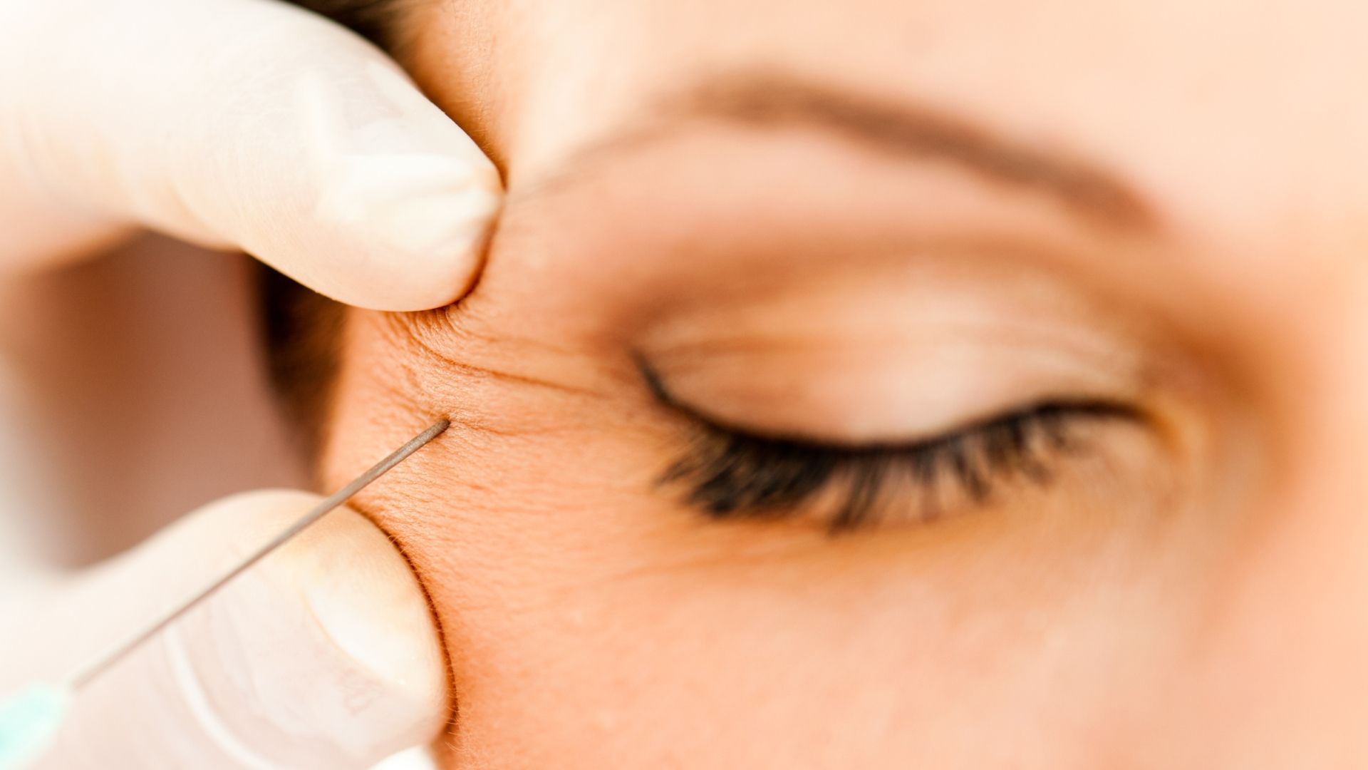The Botox Injection Process