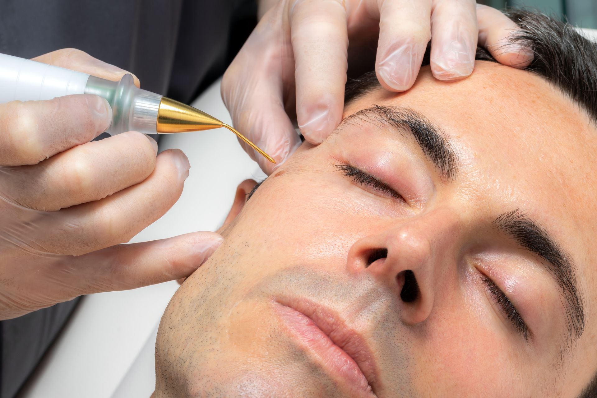 A man is getting a plasma pen treatment on his face.