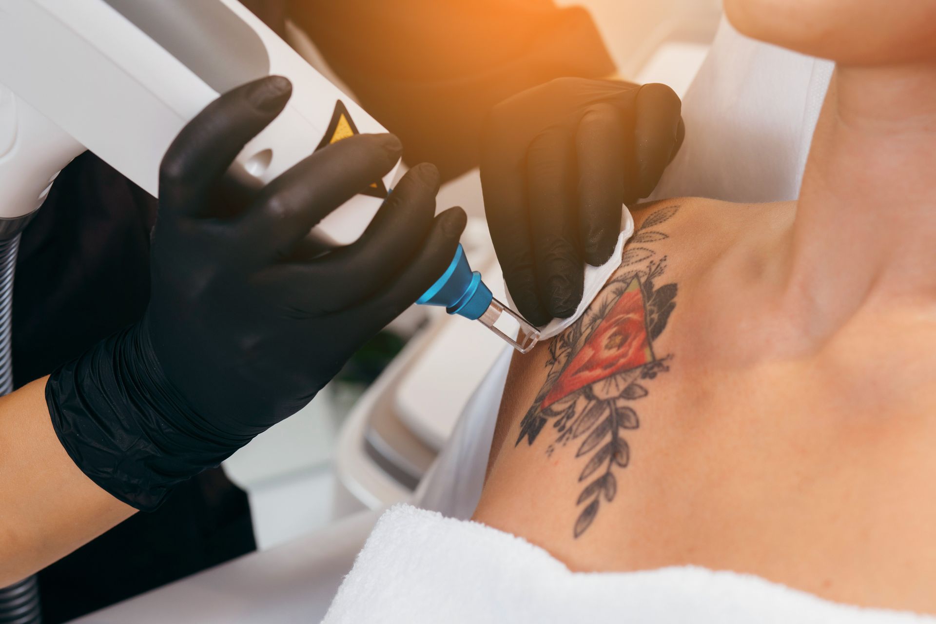 A woman is getting a tattoo removed from her shoulder.