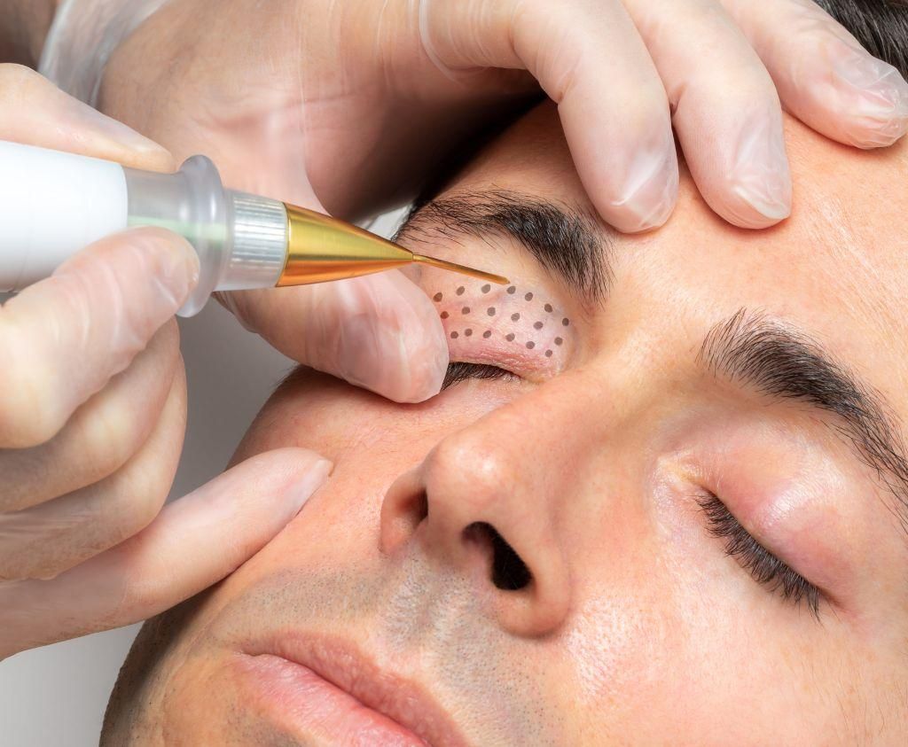 Targeted and Localized Skin Tightening Solutions