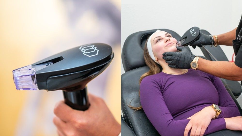 What Morpheus8 Burst Treats and Why Patients Choose It