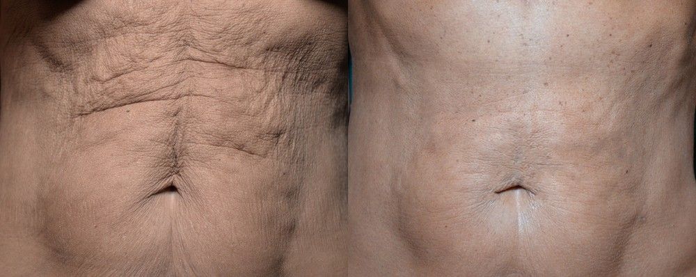 What to Expect During QuantumRF Treatment