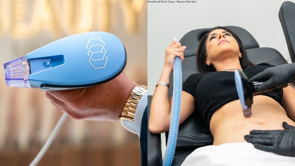 What Morpheus8 Burst Treats and Why Patients Choose It