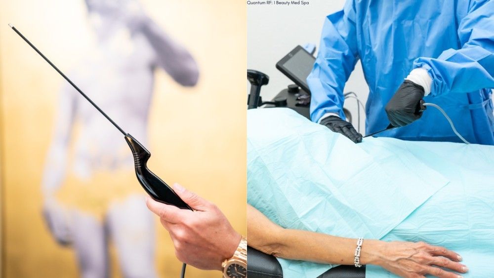 What Morpheus8 Burst Treats and Why Patients Choose It