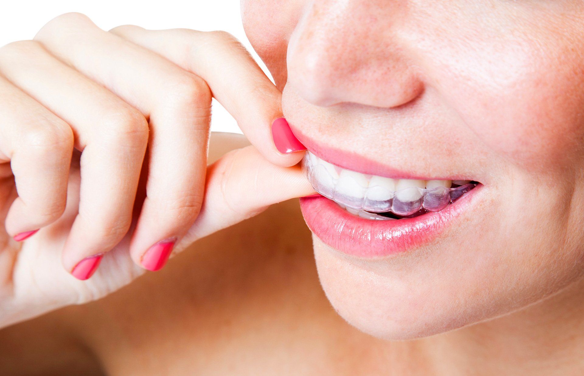 woman applying invisalign trays