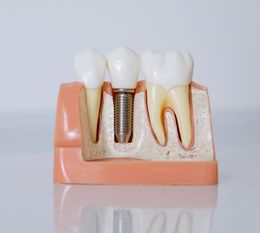 Sorriso com molda de implantes dentários a frente do rosto