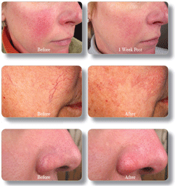 Before and After photos of Rosacea treatments performed at Hot Springs Surgery and Vein