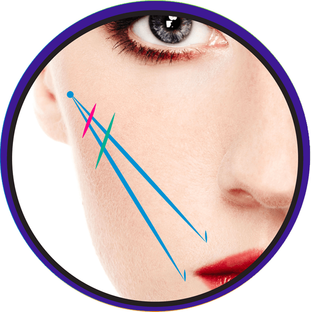 Two Vector Cheek/Commissure Lift procedure offered by Hot Springs Surgery and Vein in Hot Springs, AR