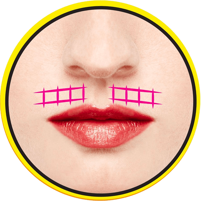 Lip Lift procedure offered by Hot Springs Surgery and Vein in Hot Springs, AR