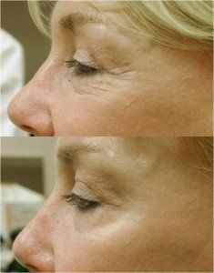 Before and After of woman who received madonna eye lift treatment from Hot Springs Surgery and Vein