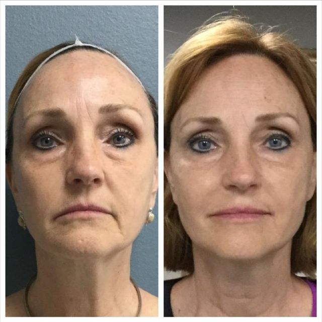 pdo thread brow lift before and after