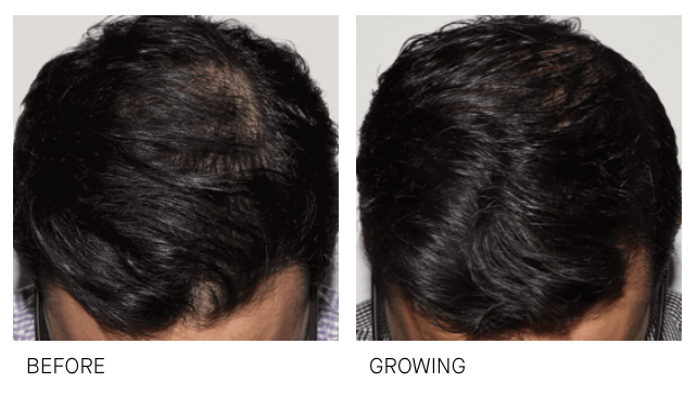 hair growth before and after