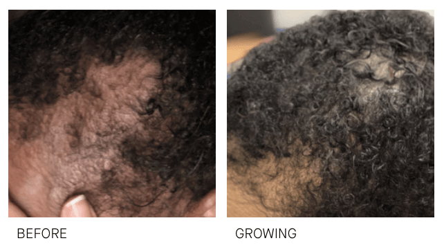 hair growth before and after