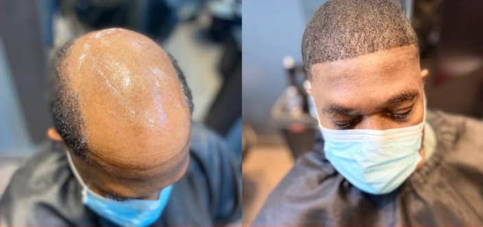 Man getting a hair transplant. Before: bald head. After: new hairline. Wearing a mask.