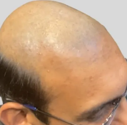 Bald head with dark hair along the sides and glasses on a light gray background.