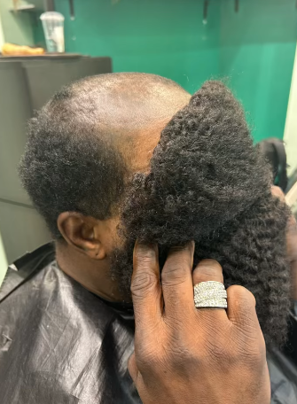 Person with partially bald head, holding dark afro-textured hair, likely for hair integration.