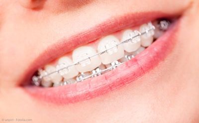 Keramik-Brackets: Weniger auffällig als Brackets aus Metall Keramik-Brackets: Weniger auffällig als Brackets aus Metall