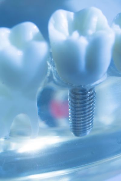 Close-up of a model tooth with a dental implant. The screw-like implant is visible with a white crown.