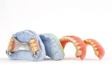 Dental models and dentures on a white background.