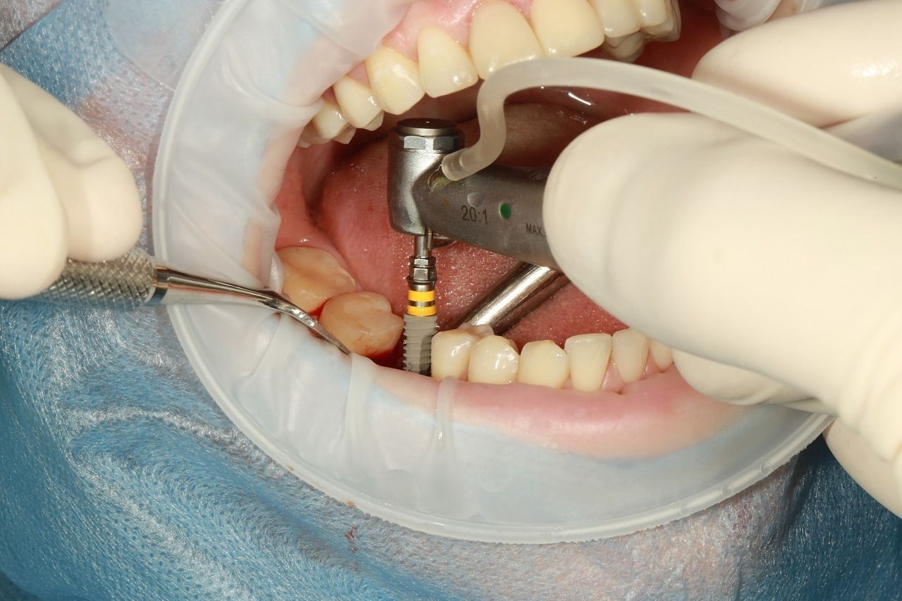 Dentist drilling into a patient's tooth during a dental procedure, with tools and equipment visible.