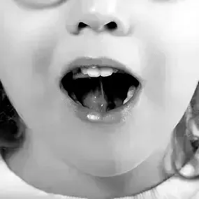 orofacial myo therapy pic