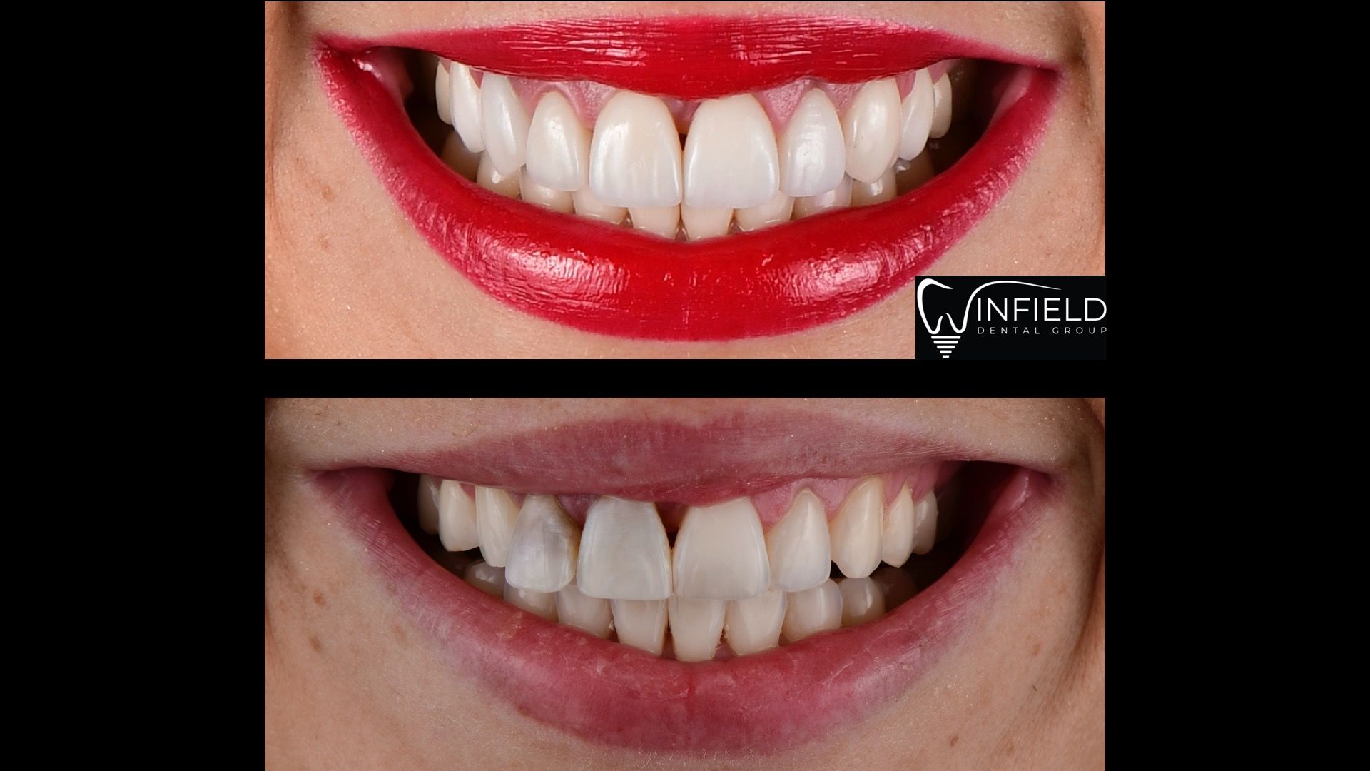 Side-by-side comparison of a smile with red lipstick above, and without lipstick below, showing teeth.