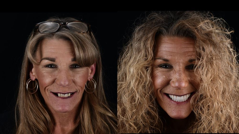 Side-by-side photo of a woman with worn teeth on the left and a bright, new smile on the right.
