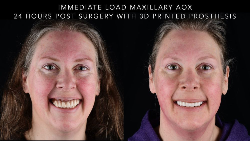Side-by-side photos of a person smiling before and after dental implant surgery with 3D-printed prosthesis.