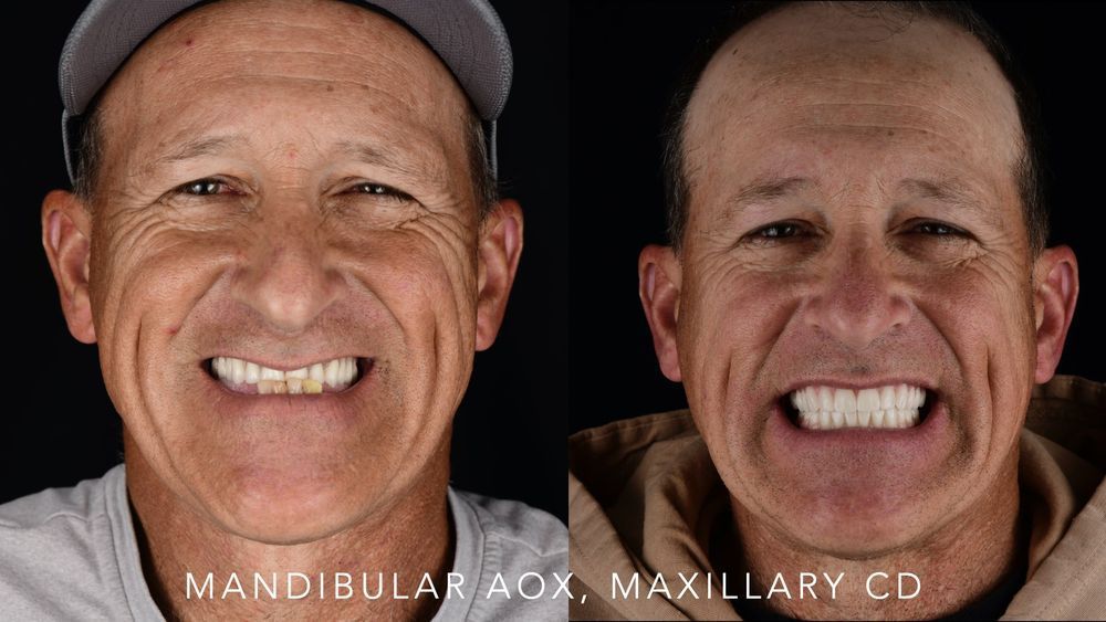 Before and after comparison of a person's smile. The
